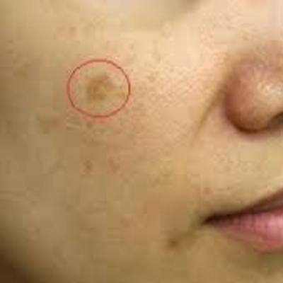 senile-pigment-freckle-2.jpg