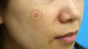 senile-pigment-freckle-2.jpg