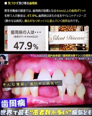 歯周病:世界で一番患者が多い病気.jpg