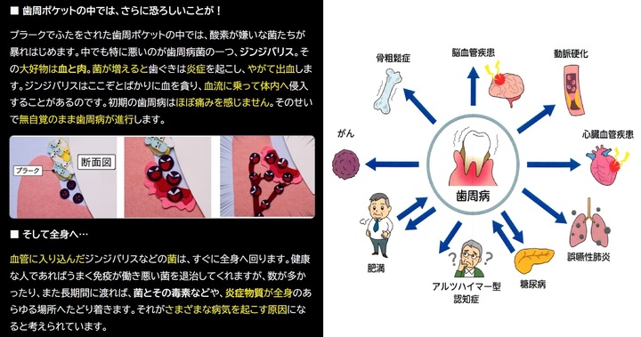 歯周病菌 ジンジバリス3.jpg