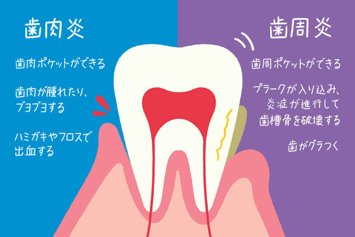 歯周病 歯を失う原因1位.jpg