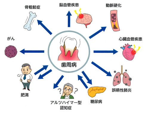 歯周病 病気.jpg